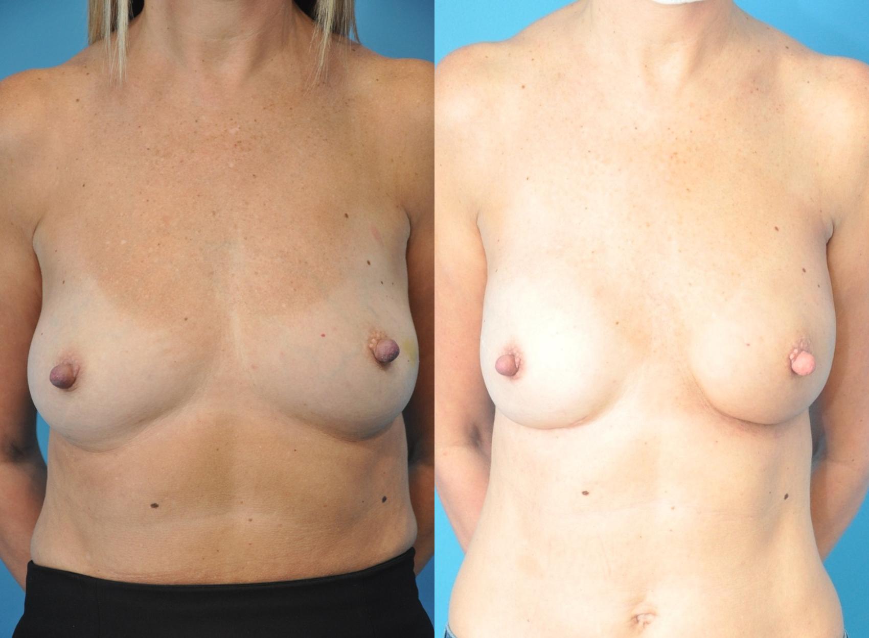 Before & After Breast Reconstruction with Implants Case 180 View #1 View in Northbrook, IL