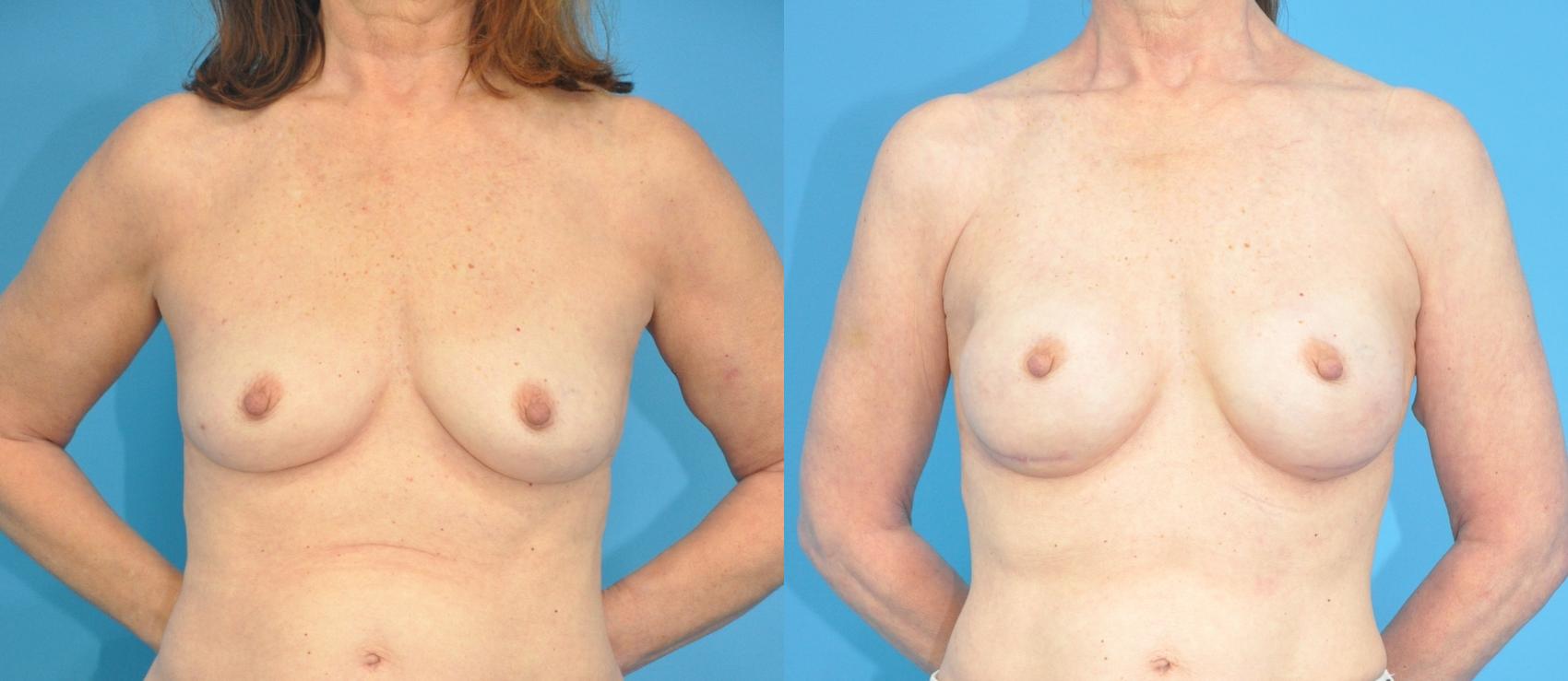 Before & After Breast Reconstruction with Implants Case 183 View #1 View in North Shore, IL