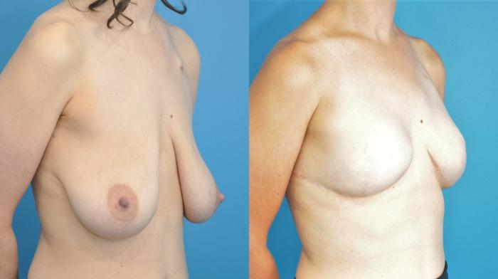 Before & After Breast Reconstruction with Implants Case 186 View #2 View in North Shore, IL