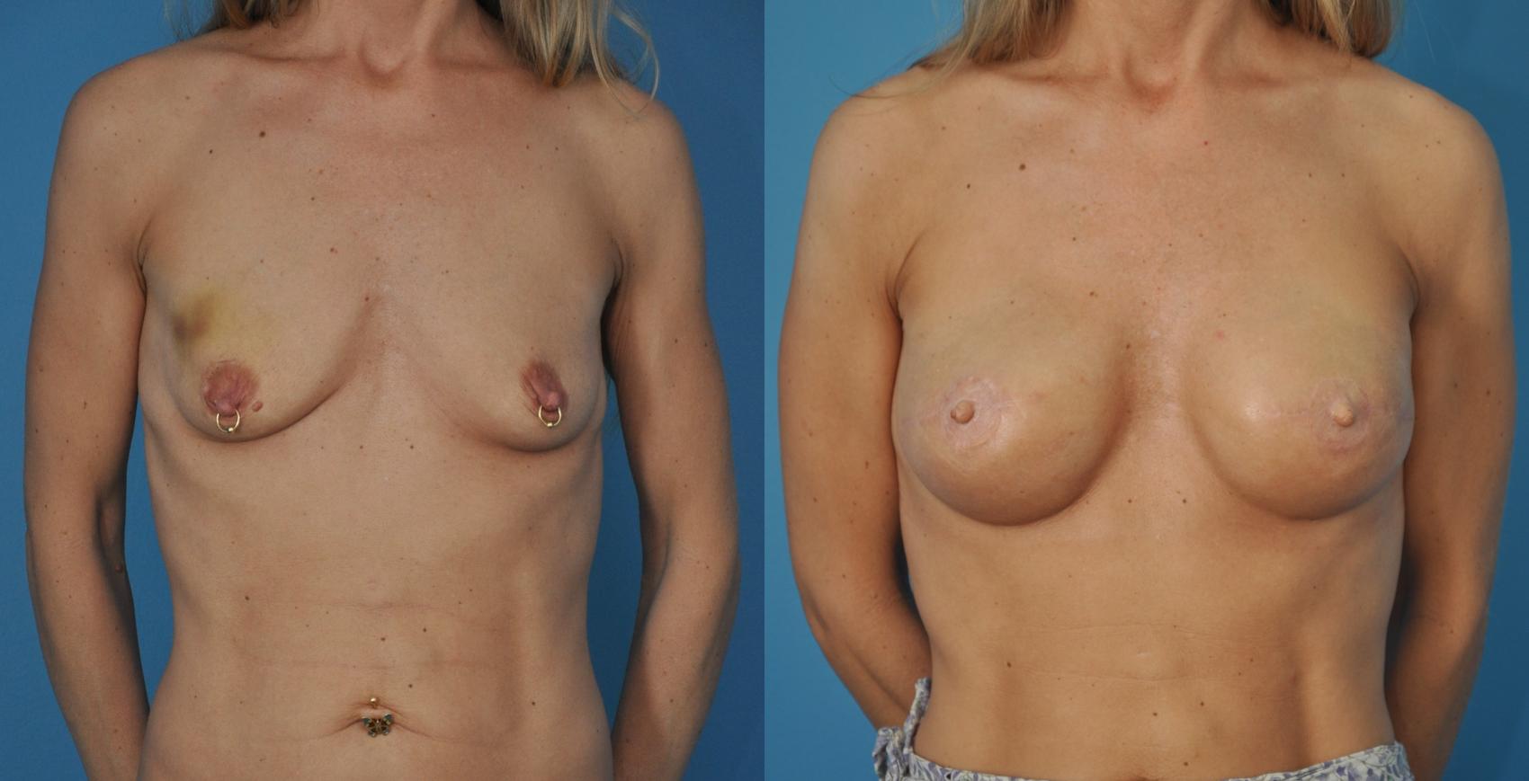 Before & After Breast Reconstruction with Implants Case 19 View #1 View in North Shore, IL