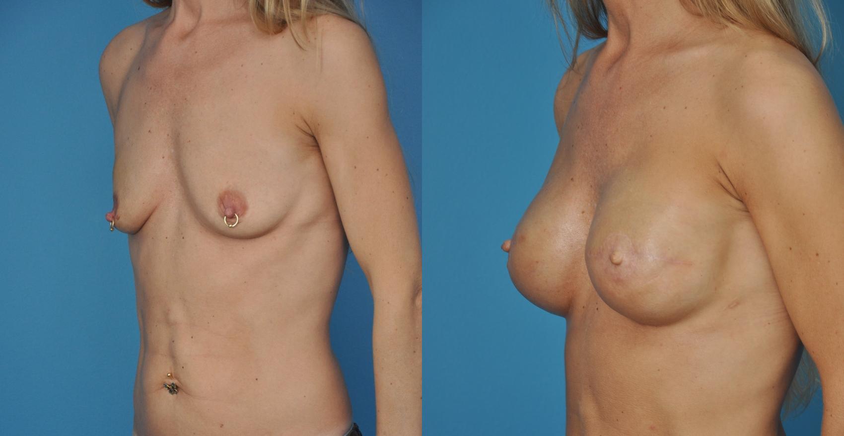 Before & After Breast Reconstruction with Implants Case 19 View #2 View in Northbrook, IL