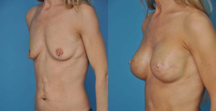 Before & After Breast Reconstruction with Implants Case 19 View #2 View in North Shore, IL