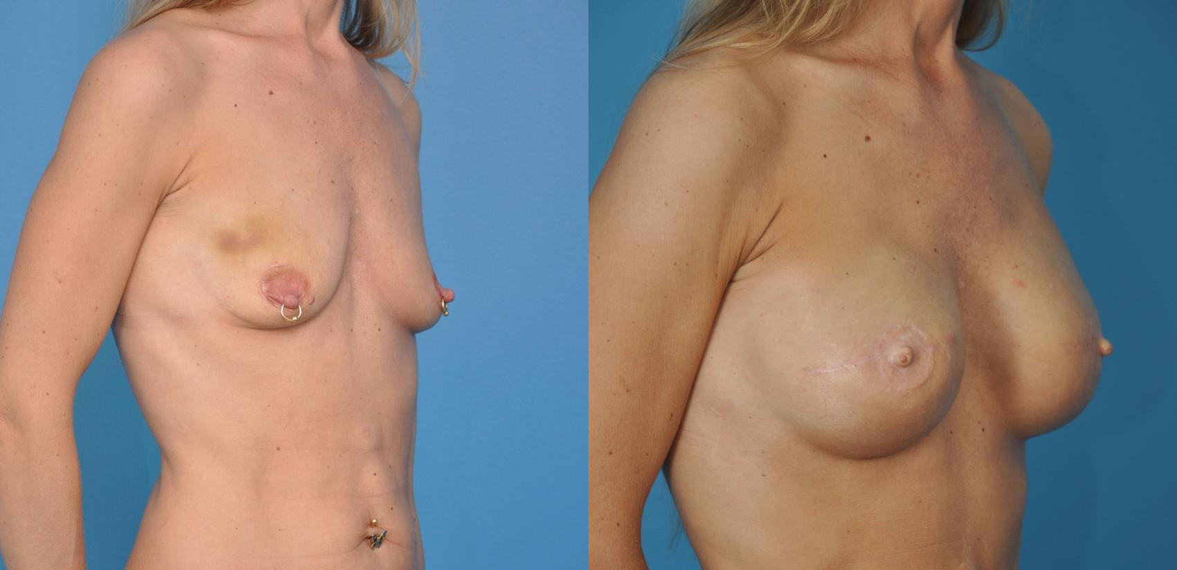 Before & After Breast Reconstruction with Implants Case 19 View #3 View in Northbrook, IL
