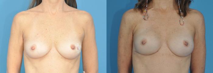 Before & After Breast Reconstruction with Implants Case 191 View #1 View in North Shore, IL