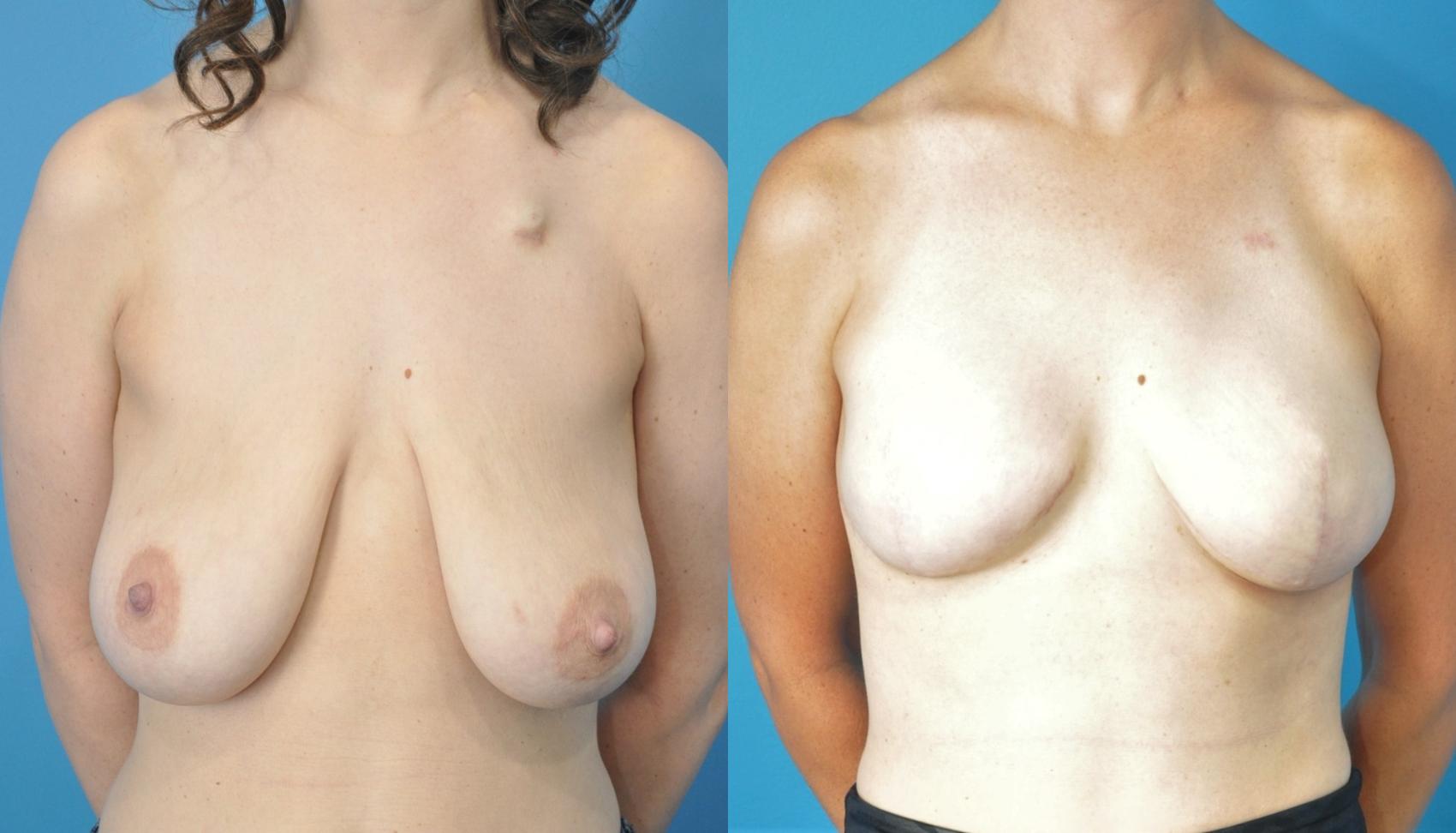 Before & After Breast Reconstruction with Implants Case 196 View #1 View in North Shore, IL