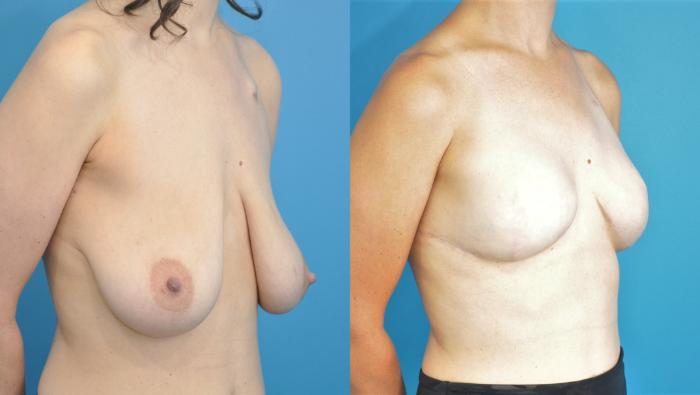 Before & After Breast Reconstruction with Implants Case 196 View #2 View in North Shore, IL
