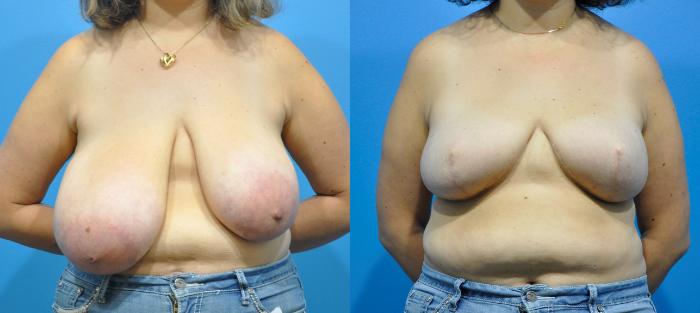 Before & After Breast Reconstruction with Implants Case 198 View #1 View in North Shore, IL
