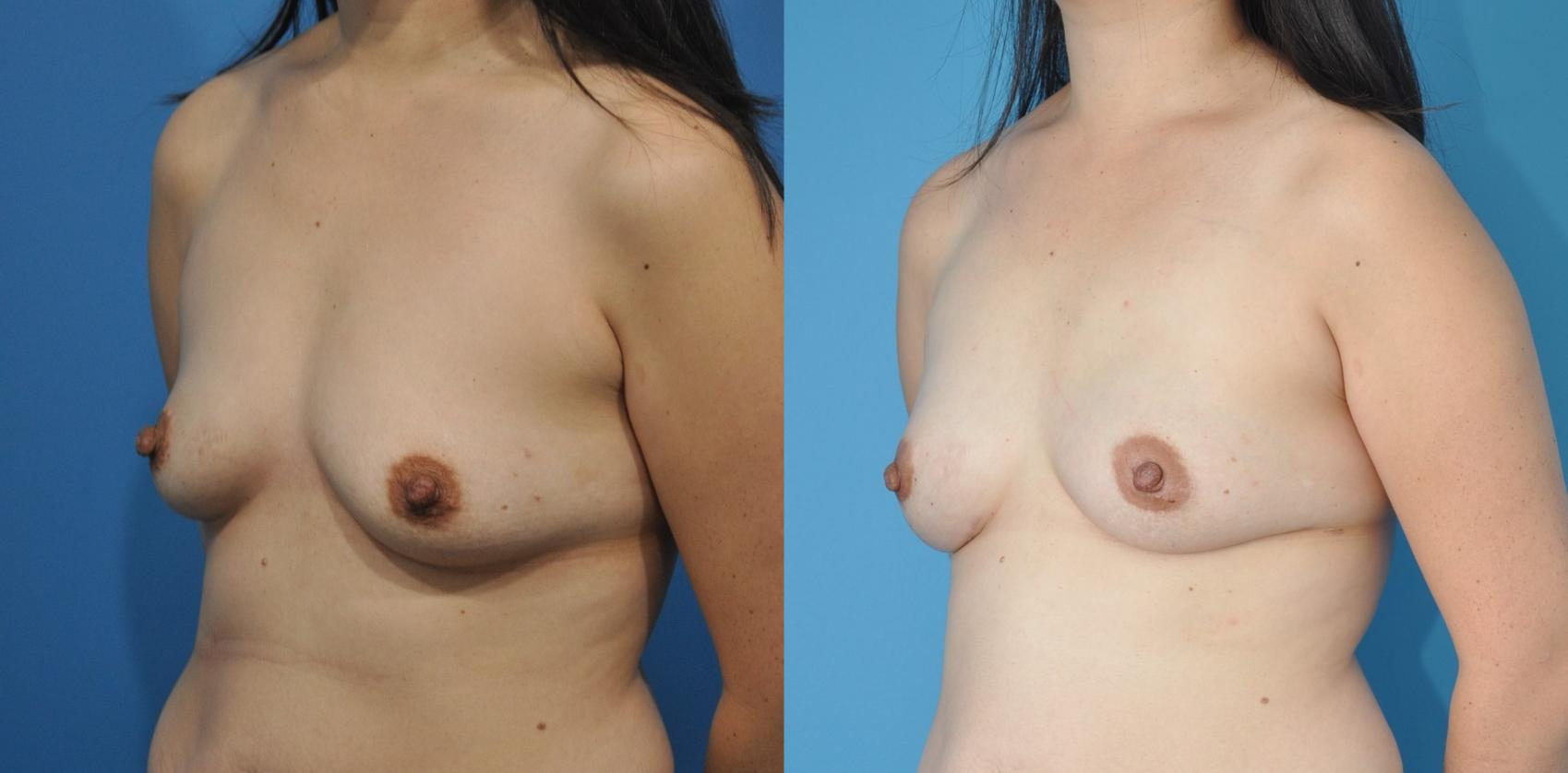Before & After Breast Reconstruction with Implants Case 199 View #1 View in Northbrook, IL