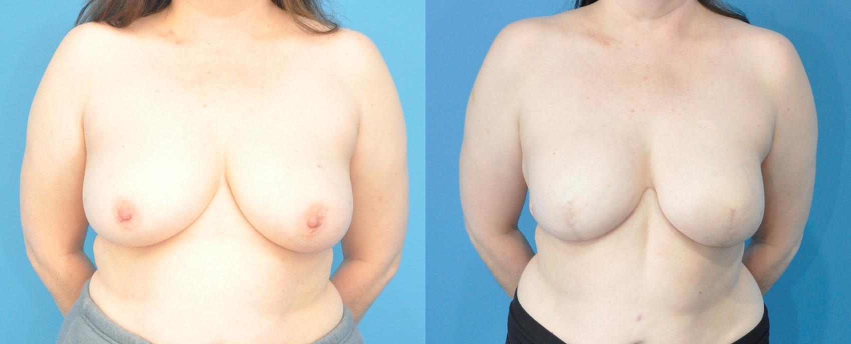 Before & After Breast Reconstruction with Implants Case 208 View #1 View in North Shore, IL