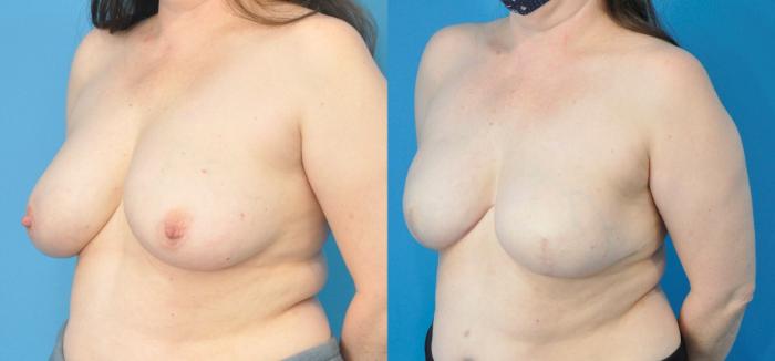 Before & After Breast Reconstruction with Implants Case 208 View #2 View in North Shore, IL