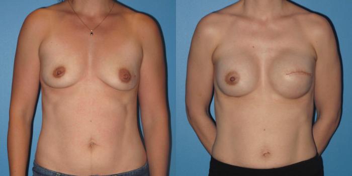 Before & After Breast Reconstruction with Implants Case 21 View #1 View in Northbrook, IL