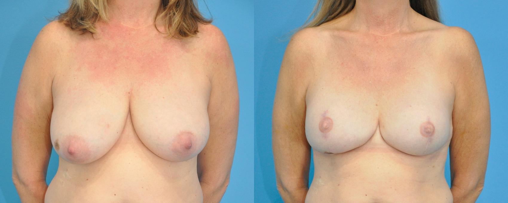 Before & After Breast Reconstruction with Implants Case 214 View #1 View in North Shore, IL