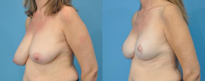 Before & After Breast Reconstruction with Implants Case 214 View #2 View in North Shore, IL