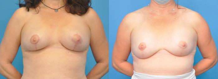 Before & After Breast Reconstruction with Implants Case 237 View #1 View in North Shore, IL