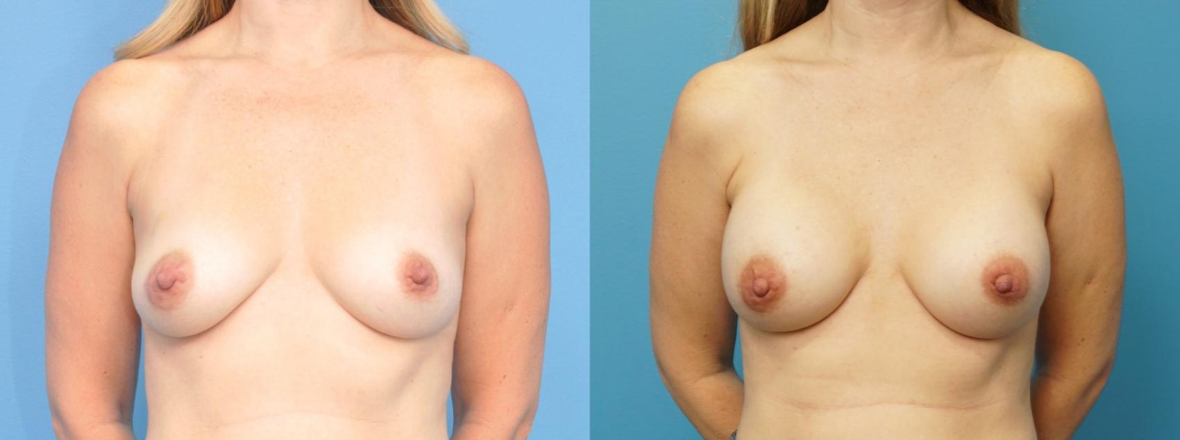 Before & After Breast Reconstruction with Implants Case 248 View #1 View in Northbrook, IL
