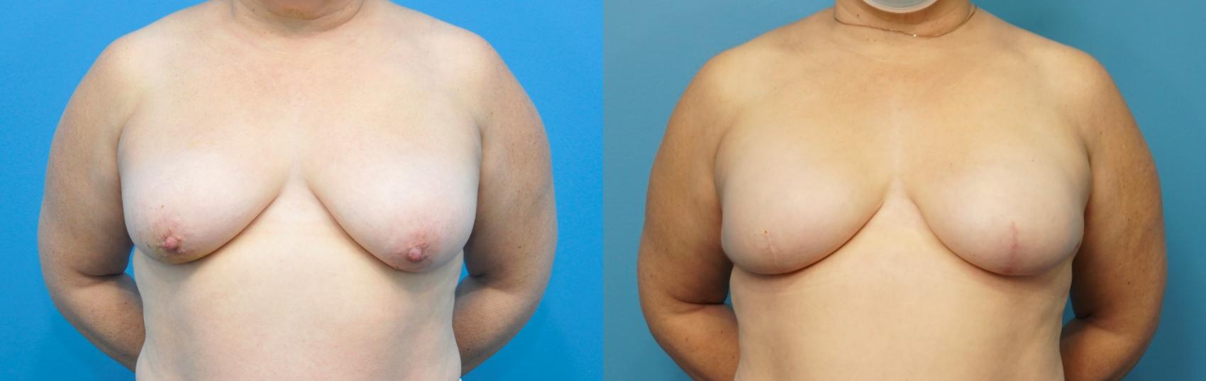 Before & After Breast Reconstruction with Implants Case 251 View #1 View in Northbrook, IL
