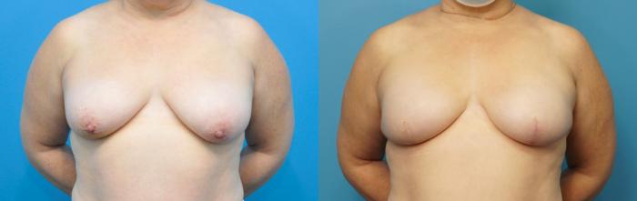 Before & After Breast Reconstruction with Implants Case 251 View #1 View in North Shore, IL