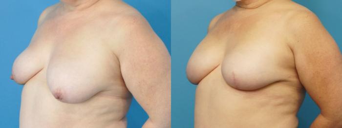 Before & After Breast Reconstruction with Implants Case 251 View #2 View in North Shore, IL