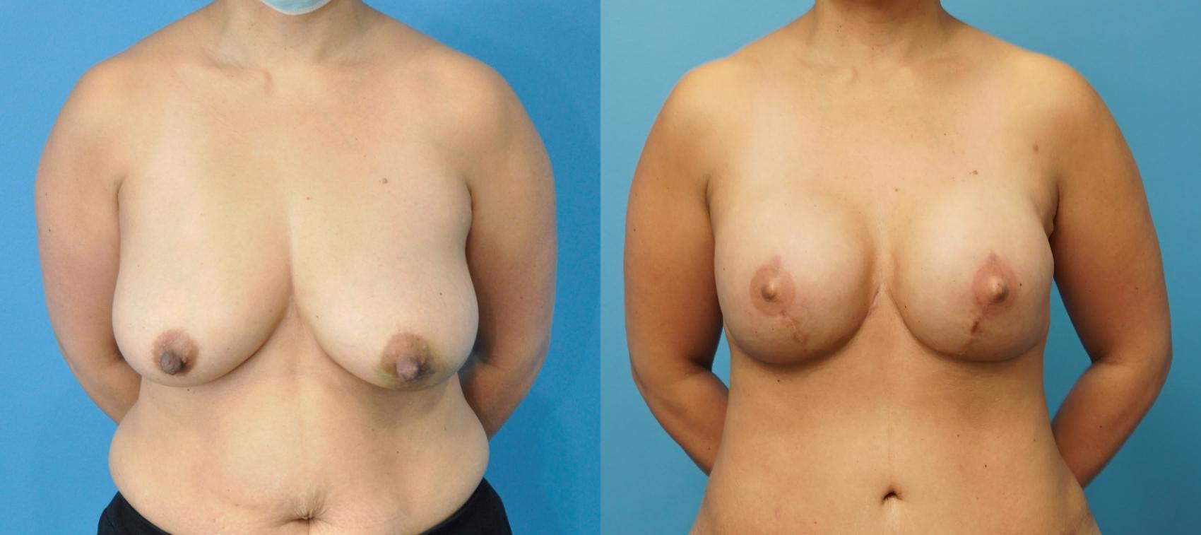 Before & After Breast Reconstruction with Implants Case 253 View #1 View in North Shore, IL