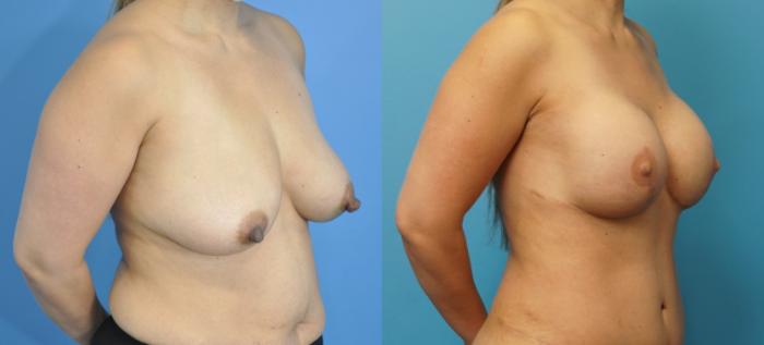 Before & After Breast Reconstruction with Implants Case 253 View #2 View in North Shore, IL