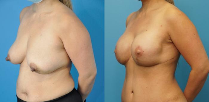 Before & After Breast Reconstruction with Implants Case 253 View #3 View in North Shore, IL