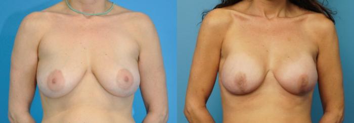 Before & After Breast Reconstruction with Implants Case 257 View #1 View in North Shore, IL
