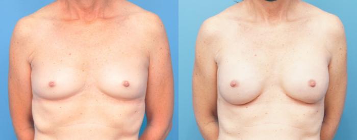 Before & After Breast Reconstruction with Implants Case 258 View #1 View in Northbrook, IL