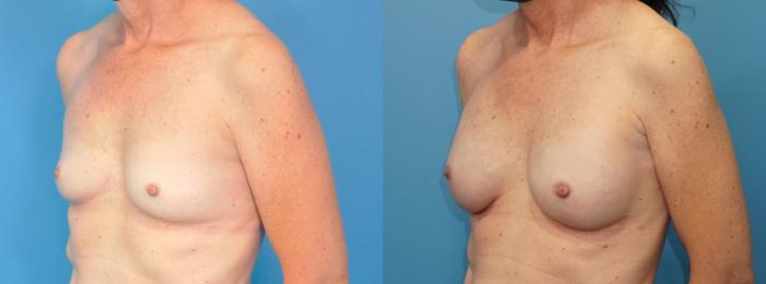 Before & After Breast Reconstruction with Implants Case 258 View #2 View in Northbrook, IL