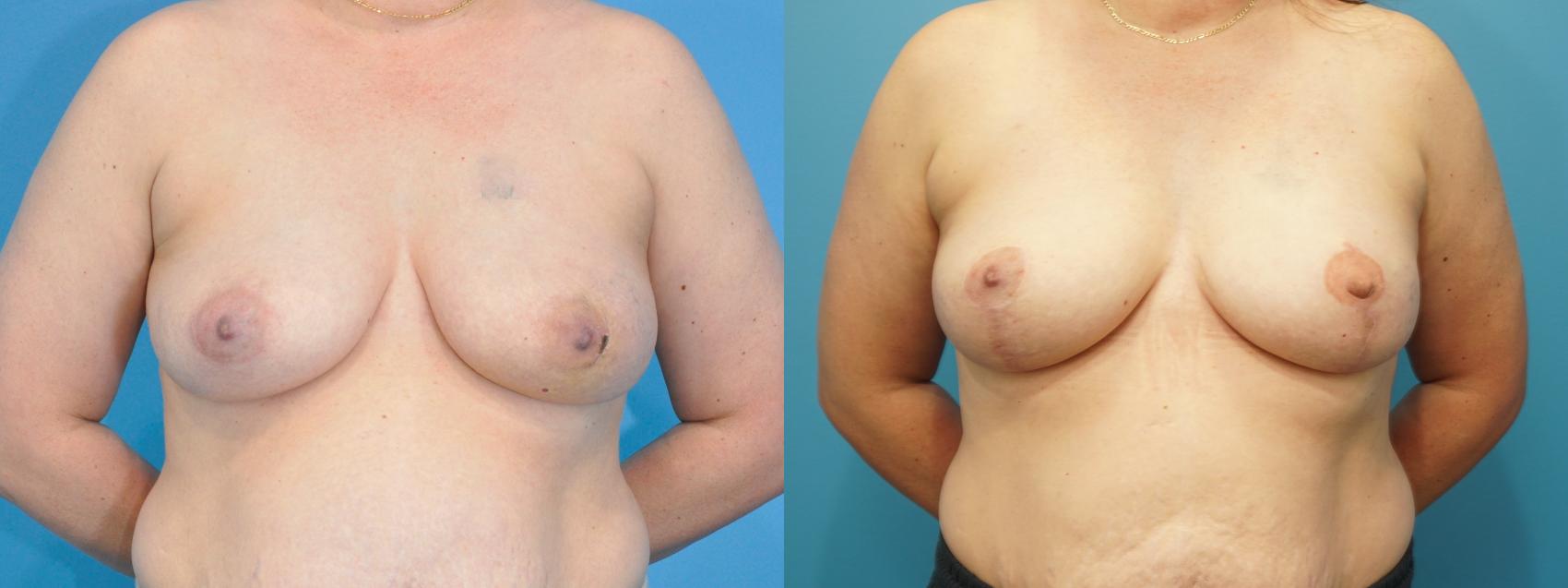 Before & After Breast Reconstruction with Implants Case 262 Front View in North Shore, IL