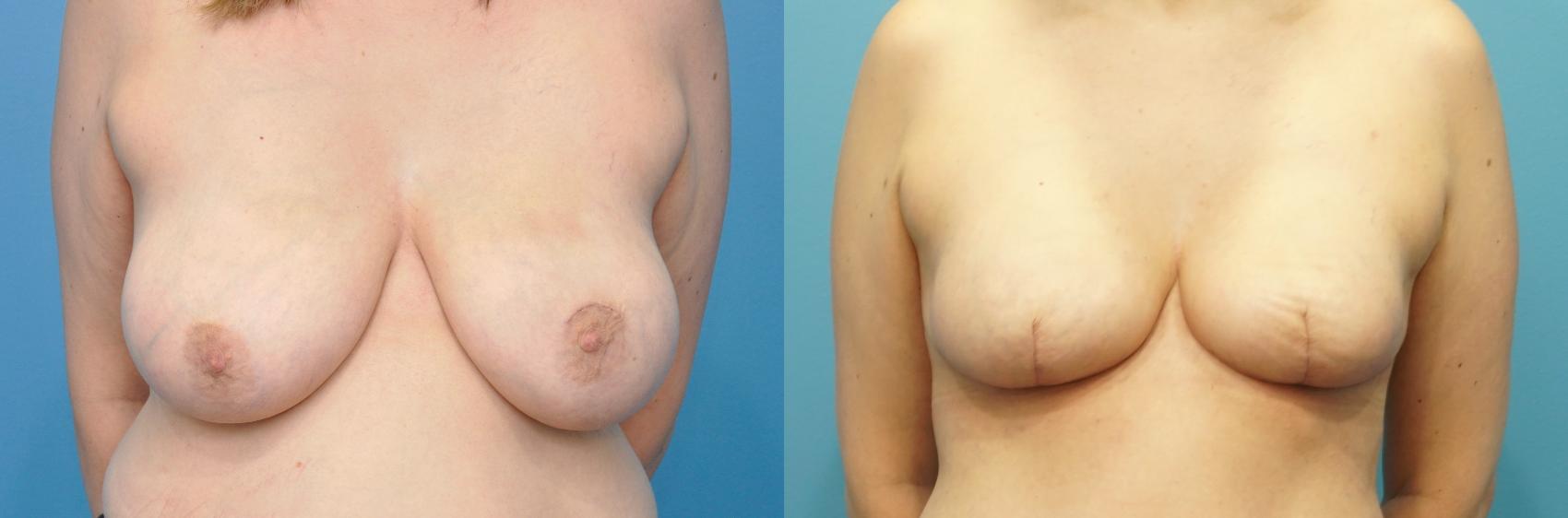 Before & After Breast Reconstruction with Implants Case 264 View #1 View in Northbrook, IL