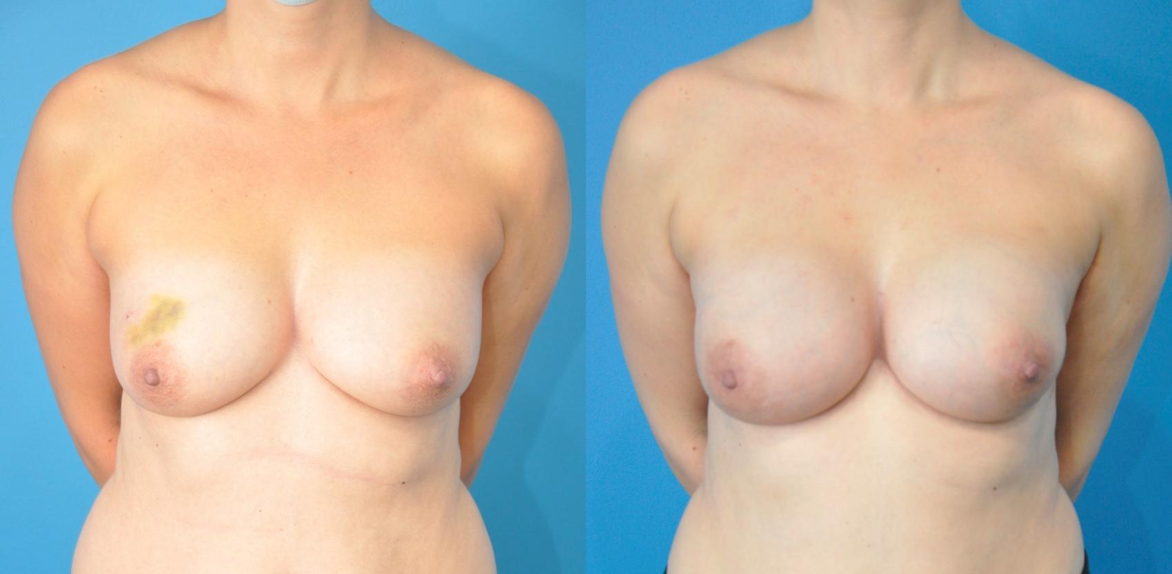 Before & After Breast Reconstruction with Implants Case 270 Front View in North Shore, IL
