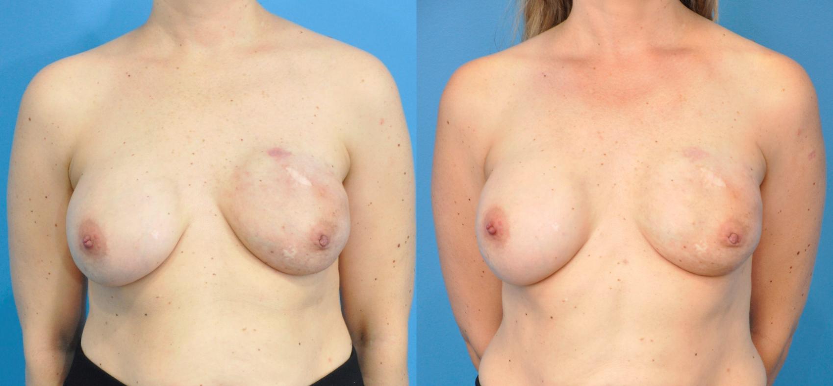 Before & After Breast Reconstruction with Implants Case 275 Front View in North Shore, IL