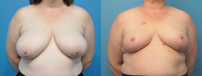 Before & After Breast Reconstruction with Implants Case 276 Front View in North Shore, IL