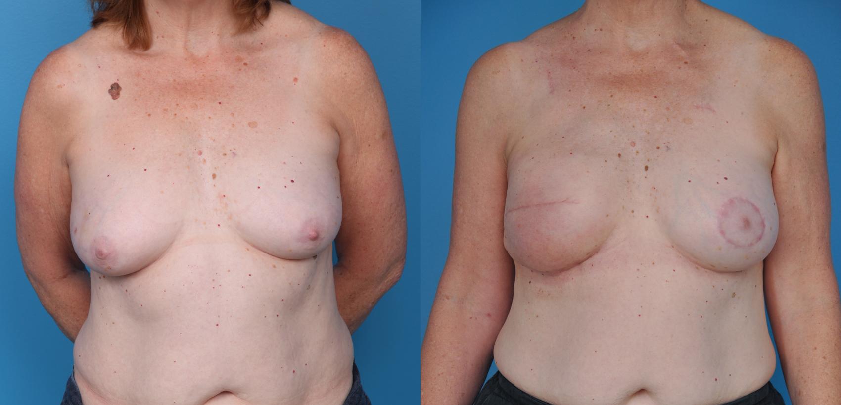 Before & After Breast Reconstruction with Implants Case 28 View #1 View in North Shore, IL