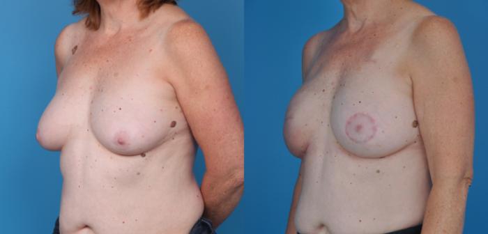 Before & After Breast Reconstruction with Implants Case 28 View #2 View in North Shore, IL