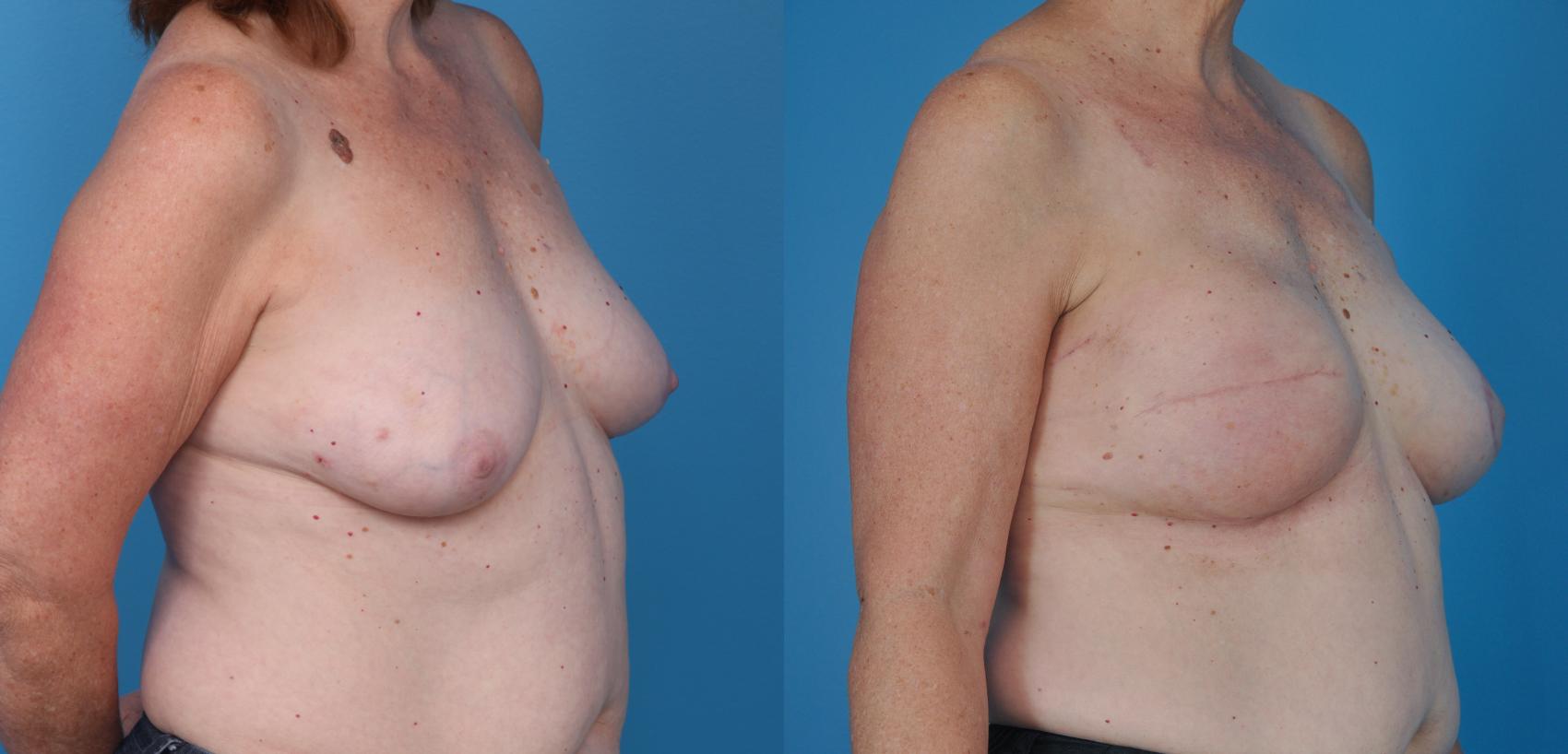 Before & After Breast Reconstruction with Implants Case 28 View #3 View in Northbrook, IL