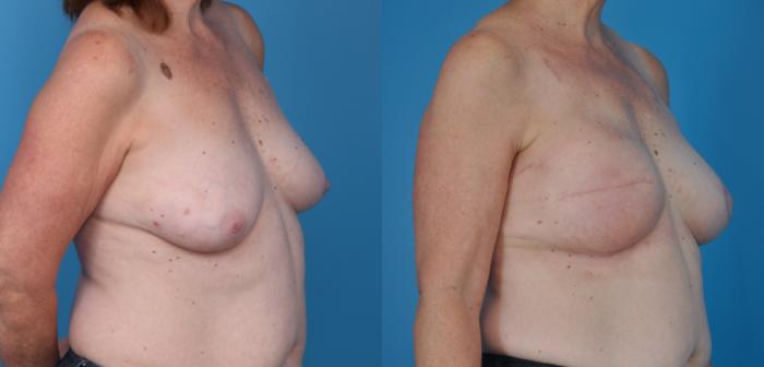Before & After Breast Reconstruction with Implants Case 28 View #3 View in North Shore, IL