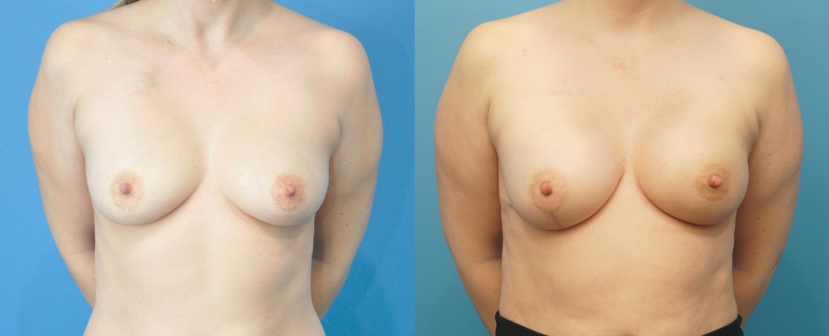 Before & After Breast Reconstruction with Implants Case 282 Front View in North Shore, IL