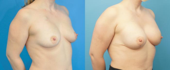 Before & After Breast Reconstruction with Implants Case 282 Right Oblique View in North Shore, IL