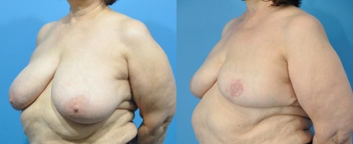 Before & After Breast Reconstruction with Implants Case 283 Left Oblique View in North Shore, IL
