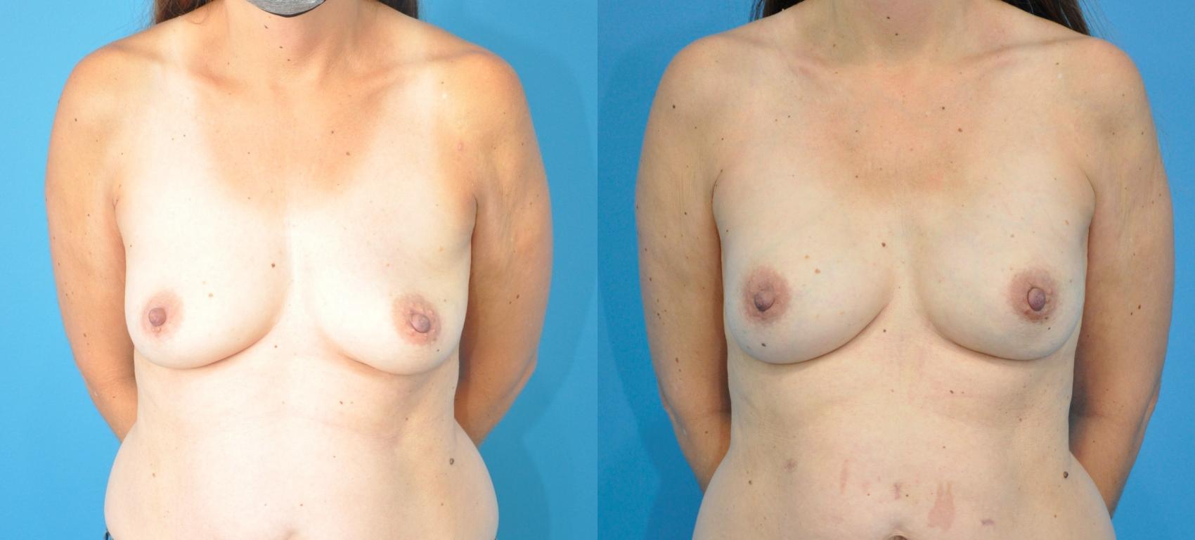 Before & After Breast Reconstruction with Implants Case 284 Front View in North Shore, IL