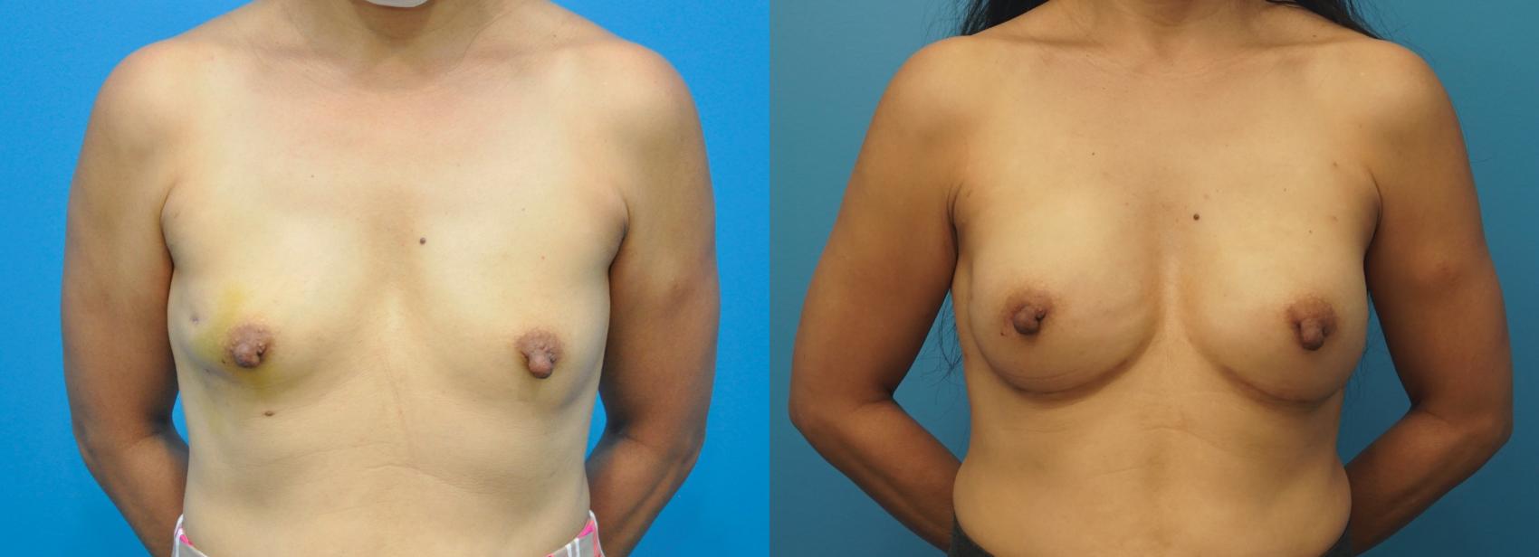 Before & After Breast Reconstruction with Implants Case 285 Front View in North Shore, IL