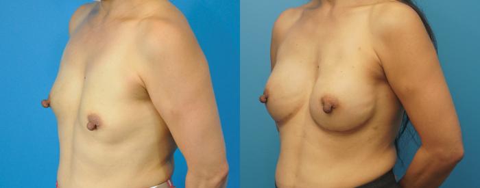 Before & After Breast Reconstruction with Implants Case 285 Left Oblique View in North Shore, IL
