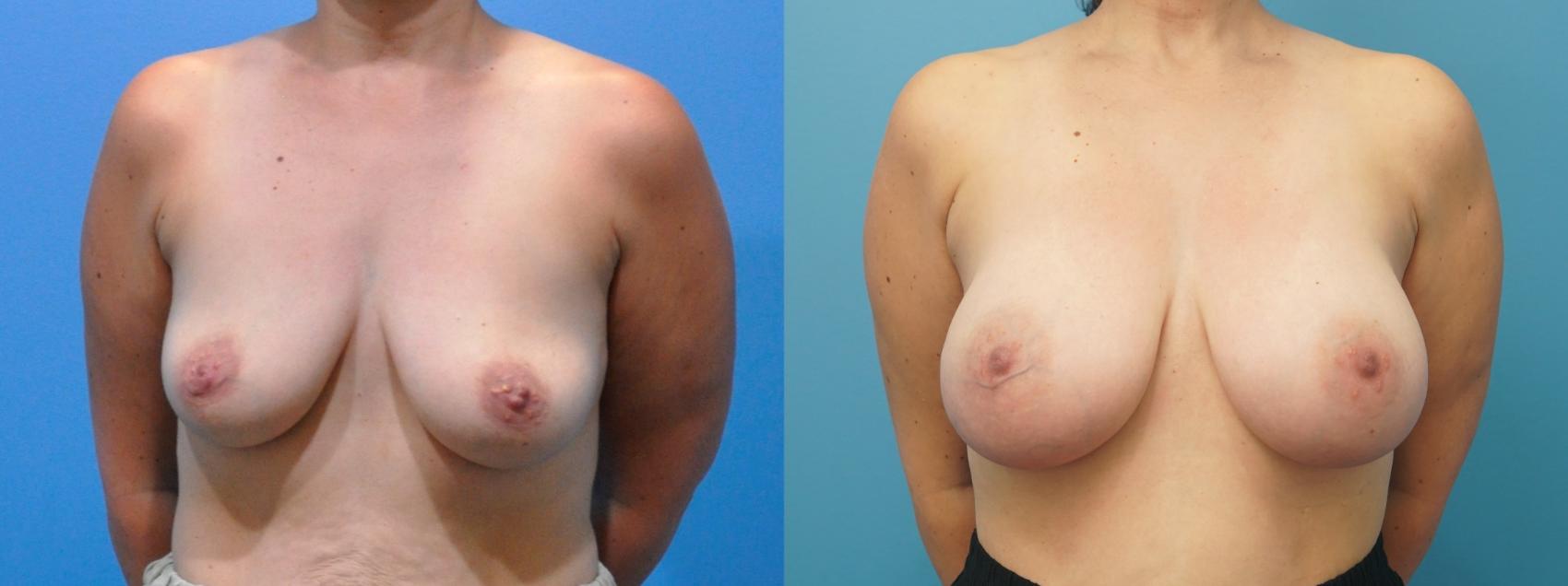 Before & After Breast Reconstruction with Implants Case 286 Front View in North Shore, IL
