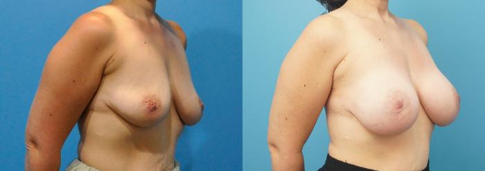 Before & After Breast Reconstruction with Implants Case 286 Right Oblique View in North Shore, IL