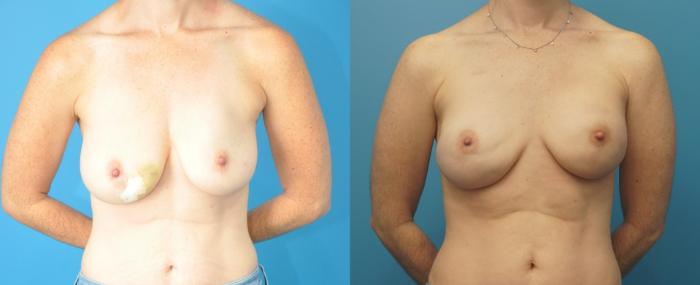 Before & After Breast Reconstruction with Implants Case 287 Front View in North Shore, IL