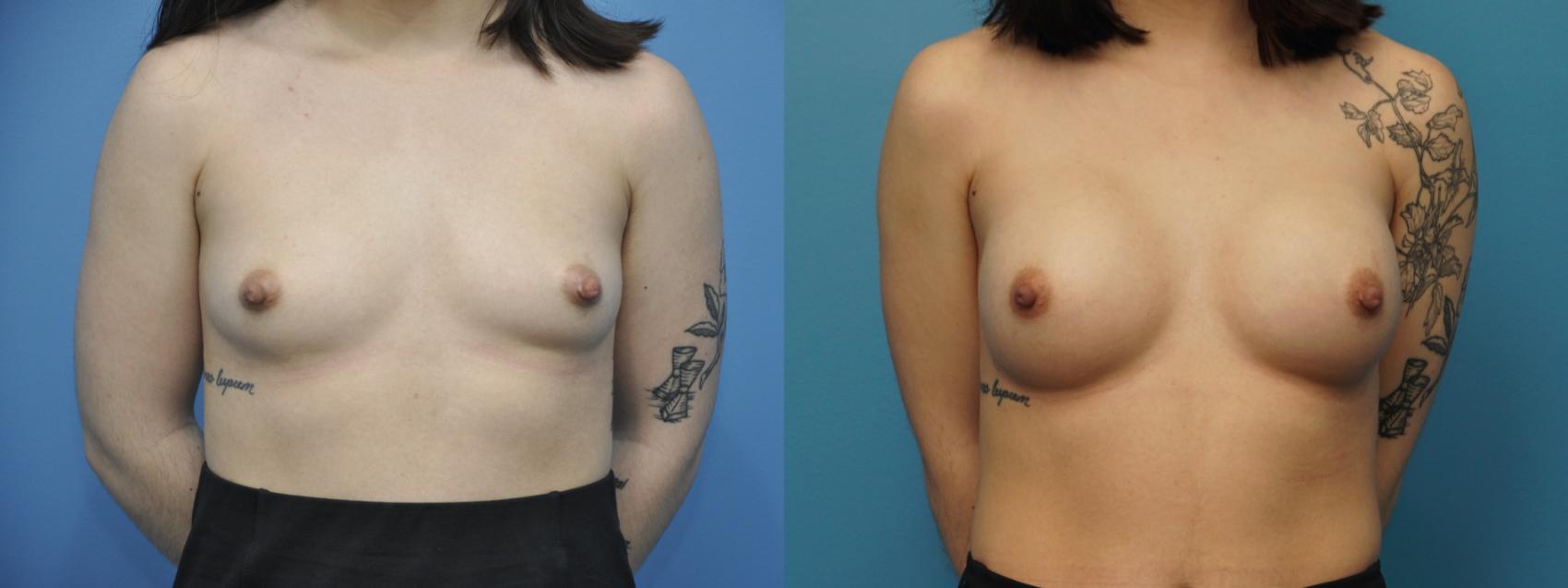 Before & After Breast Reconstruction Case 302 View #1 View in Northbrook, IL