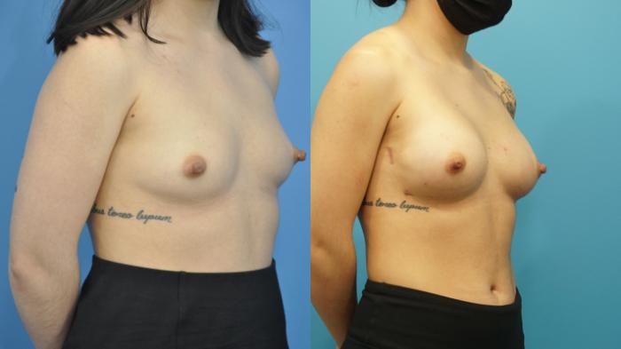 Before & After Breast Reconstruction with Implants Case 302 View #2 View in North Shore, IL