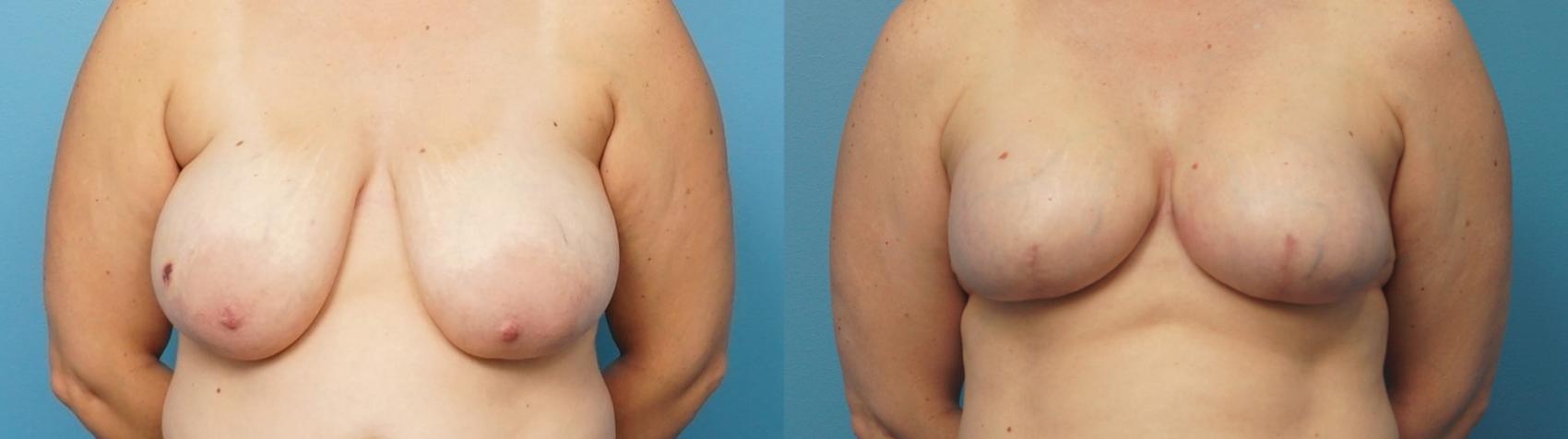 Before & After Breast Reconstruction with Implants Case 309 View #1 View in North Shore, IL