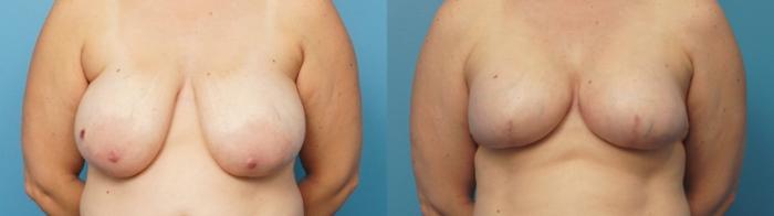 Before & After Breast Reconstruction Case 309 View #1 View in Northbrook, IL